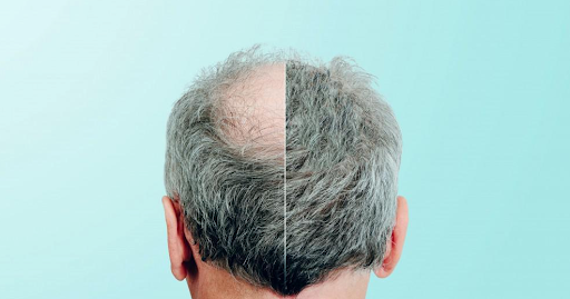 How Laser Caps are Replacing Hair Transplant