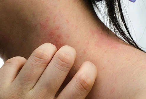 The Basic Types Of Contact Dermatitis And How To Rescue Your Skin