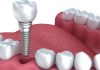 Everything You Need to Know About Affordable Dental Implants